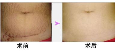 激光祛妊娠纹视频