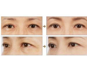 射频消融去眼袋视频,焕发青春光彩